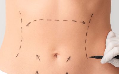 Abdominoplastia: qué es, cuándo se recomienda y cómo es la recuperación
