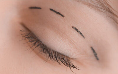 Blefaroplastia: preguntas frecuentes sobre la cirugía de párpados